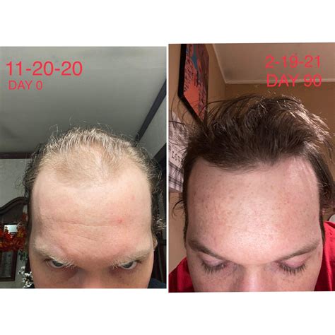 What it can do is increase density in the areas behind the <b>hairline</b> that are in the process of thinning. . Minoxidil microneedling hairline reddit